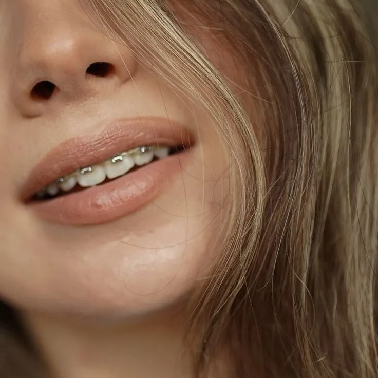 Clínica Fernández Baca Dental tratamiento brackets metalicos