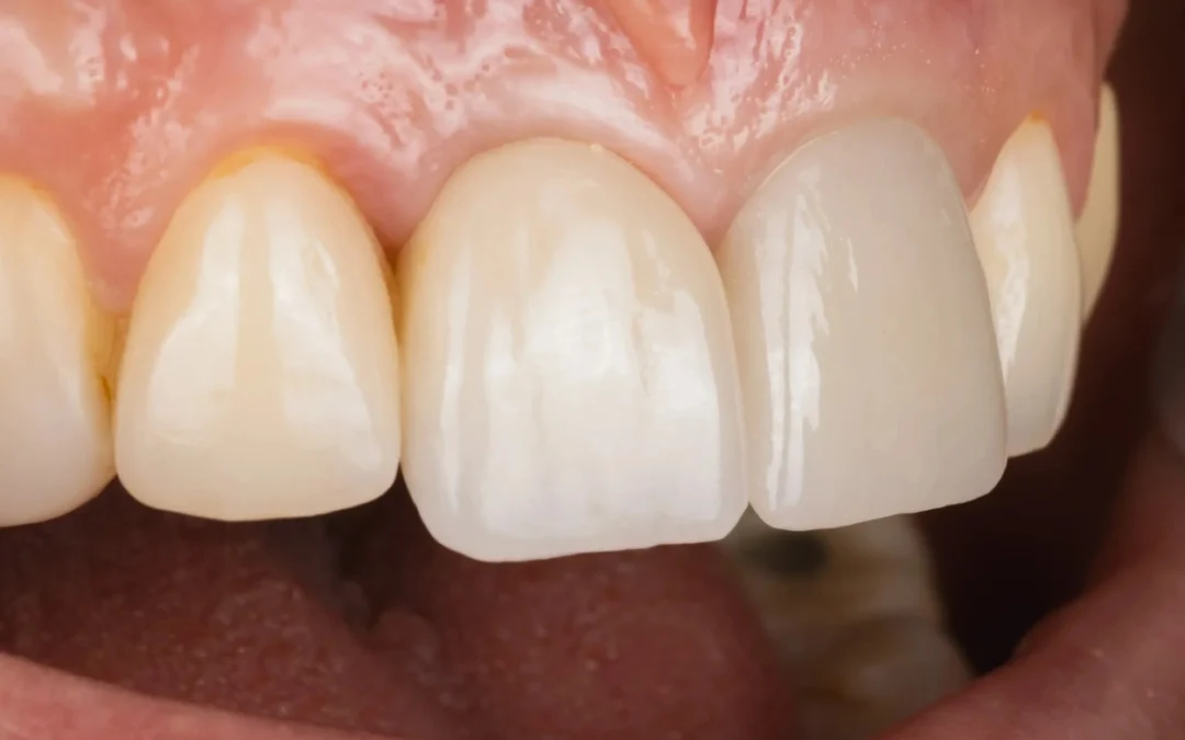 ¿Porqué algunas personas no pueden colocarse implantes dentales inmediatos?