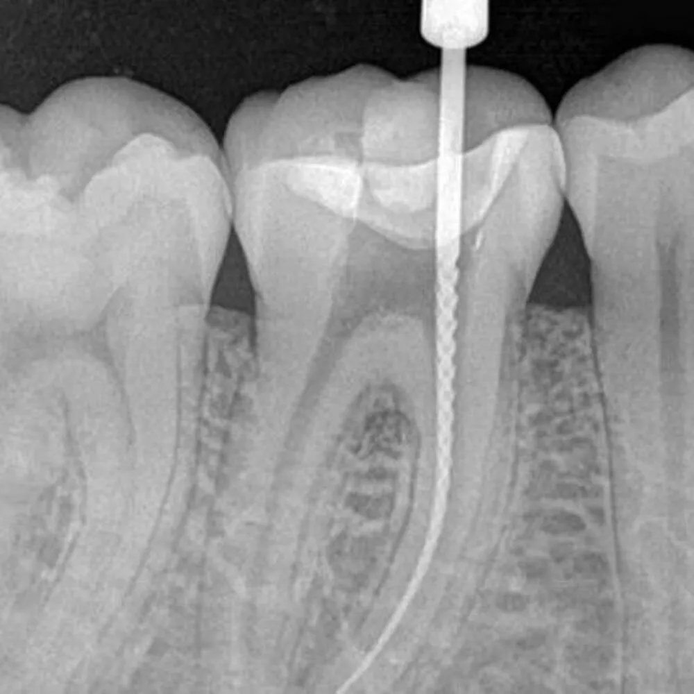 clinica dental baca tratamiento endodoncia