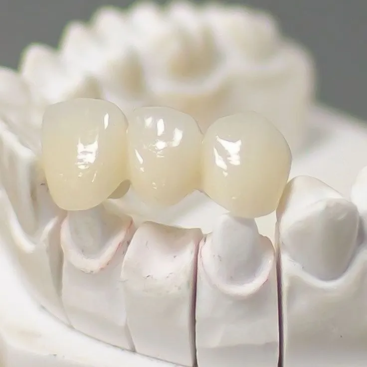clinica dental fernandez baca protesis fija tratamiento