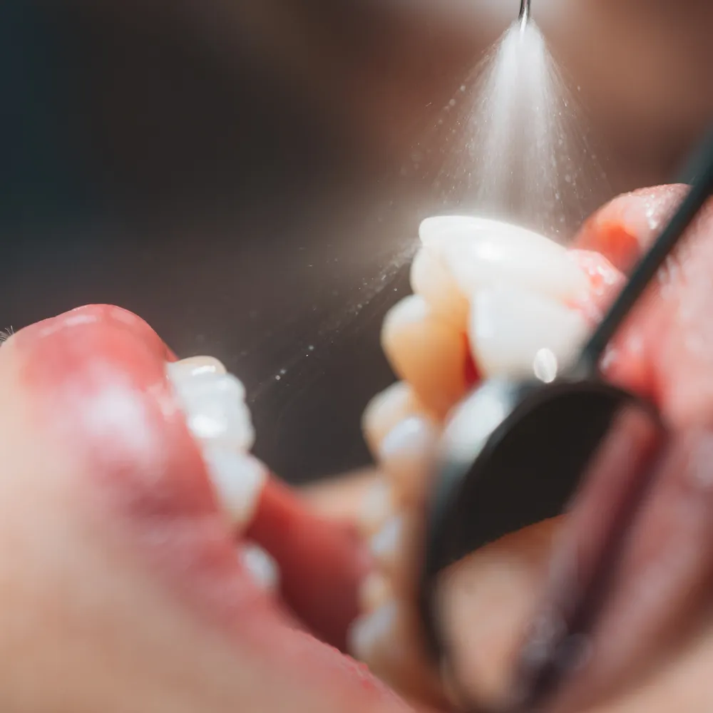 clinica dental fernandez baca tratamiento de higiene dental